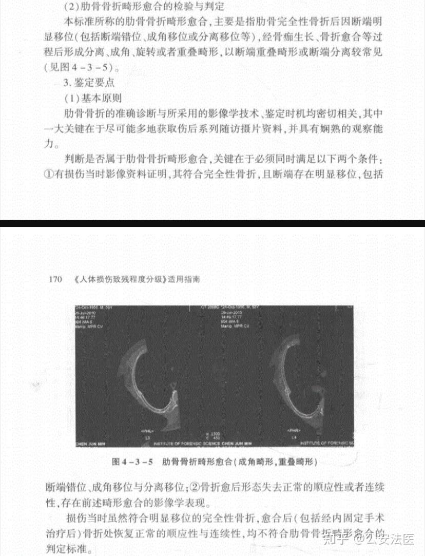 肋骨骨折畸形愈合是啥样的请问有图片吗