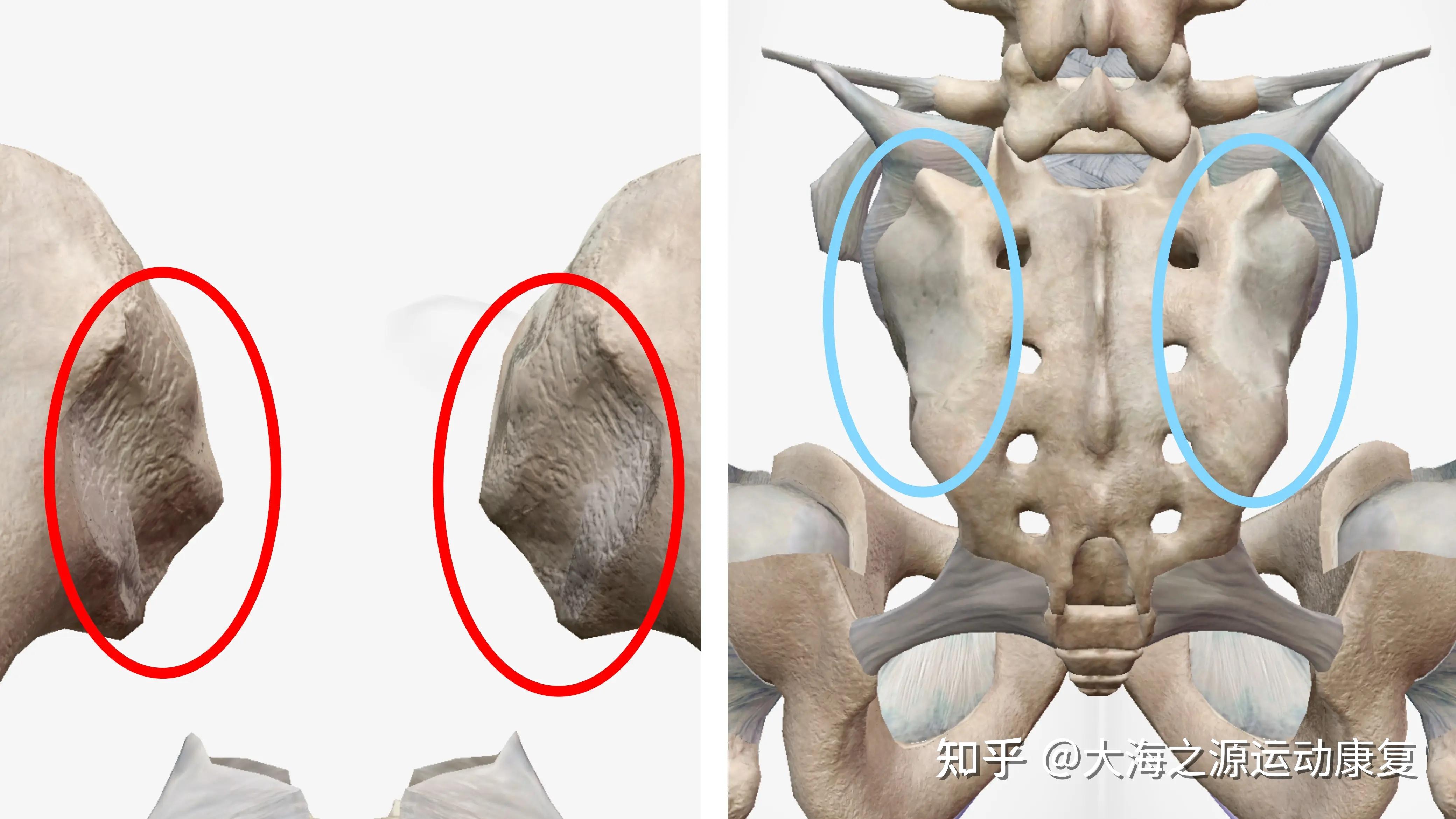 听说过"骶髂关节炎"吗?
