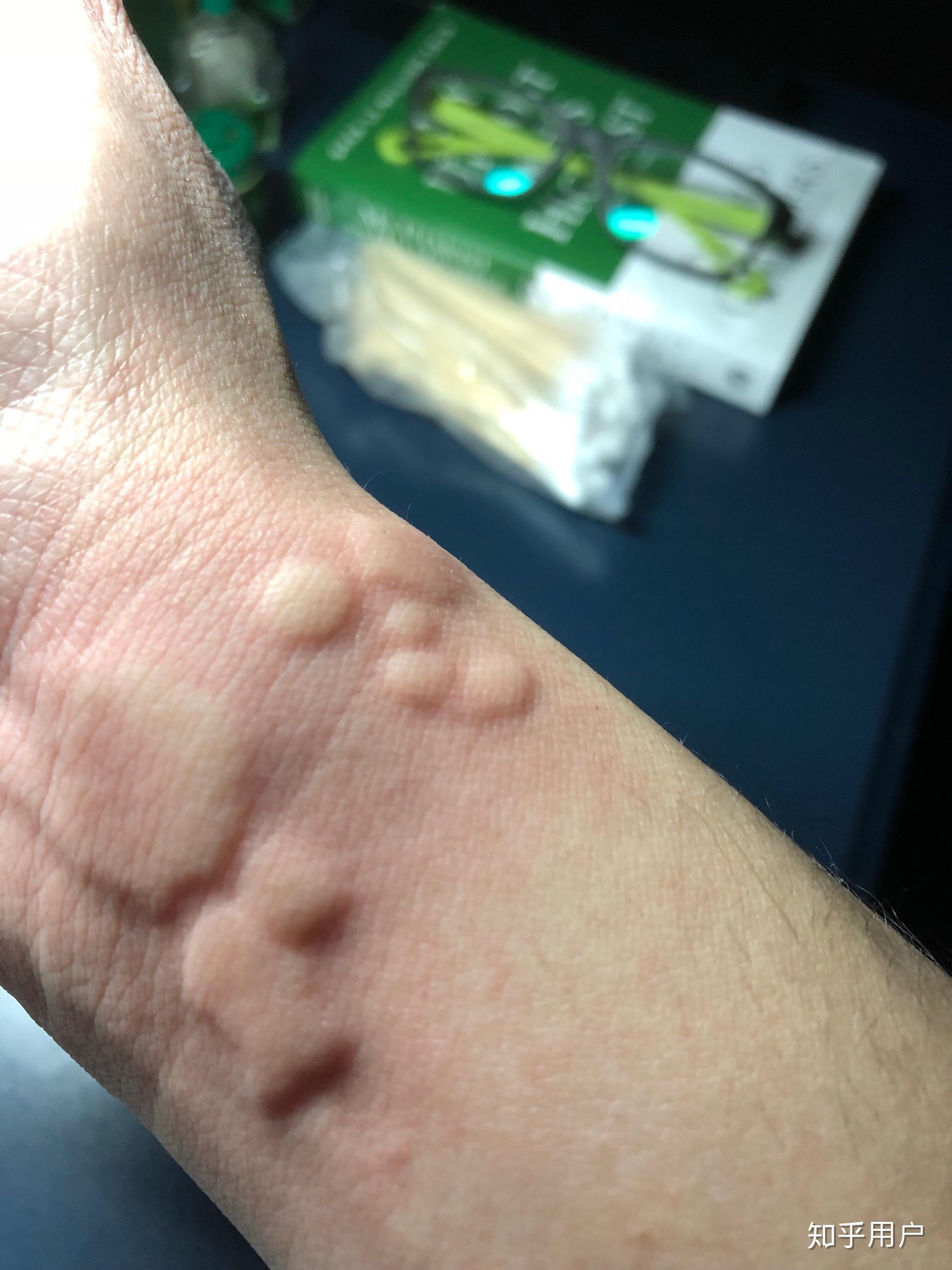 有没有小伙伴和我一样的荨麻疹症状,上图? - 知乎