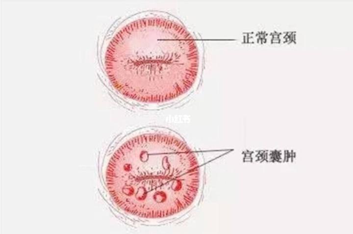 宫颈纳囊是什么意思图片