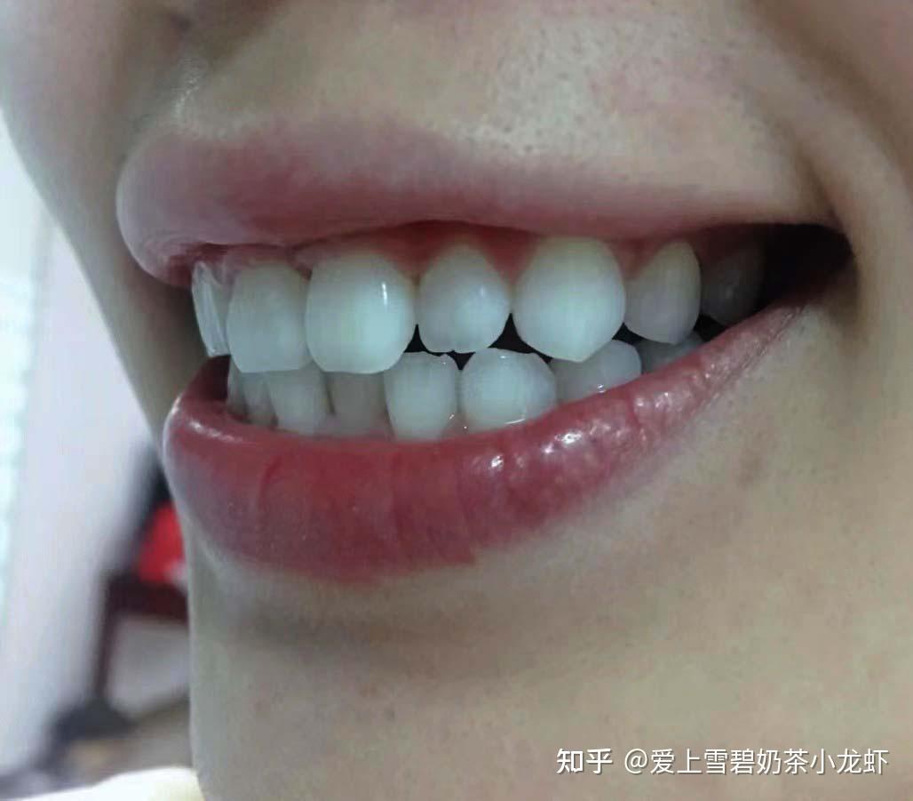 我天天刷牙,可是牙齿还是有点发黄,有什么好的办法可以使牙齿变白?