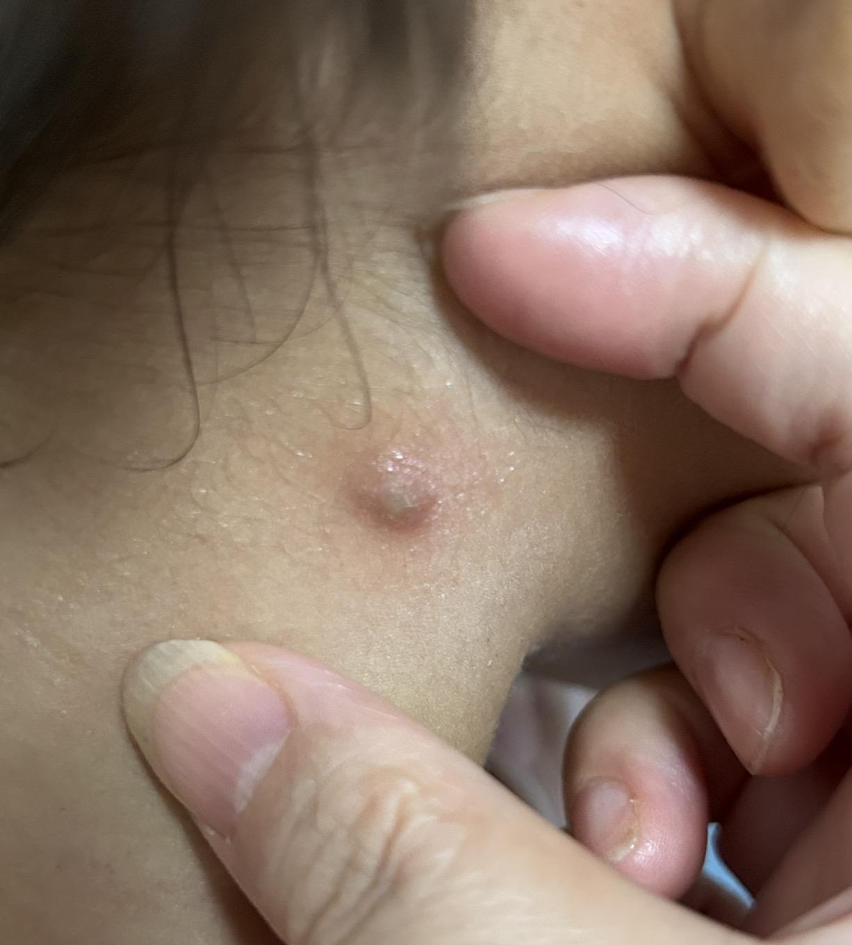 毛囊炎、疖、痈、皮脂腺囊肿怎么区分? - 知乎