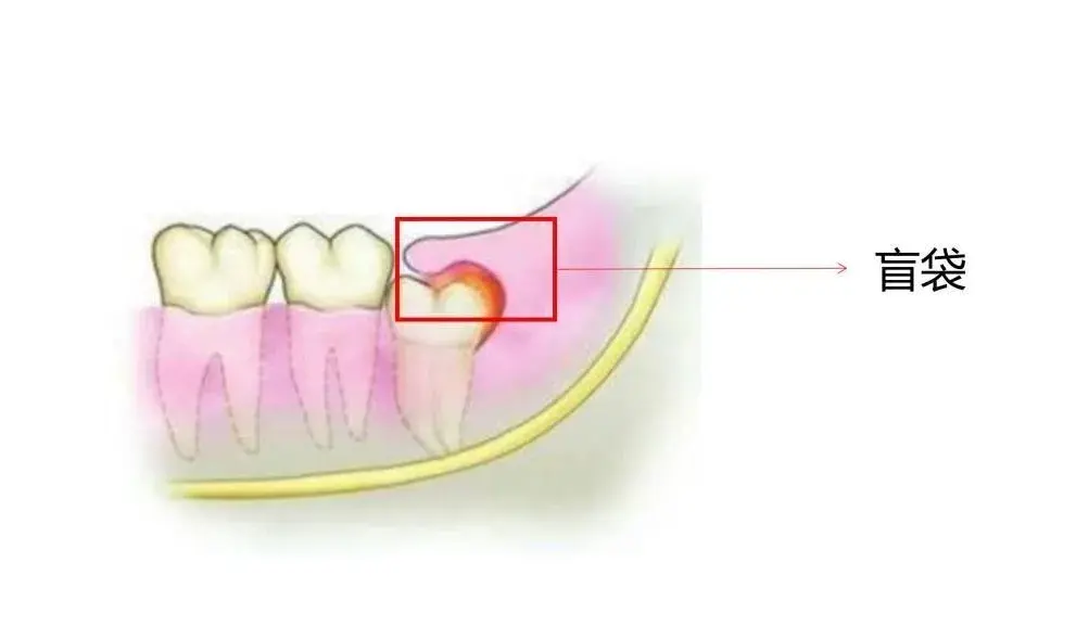 智齿一定要拔掉吗