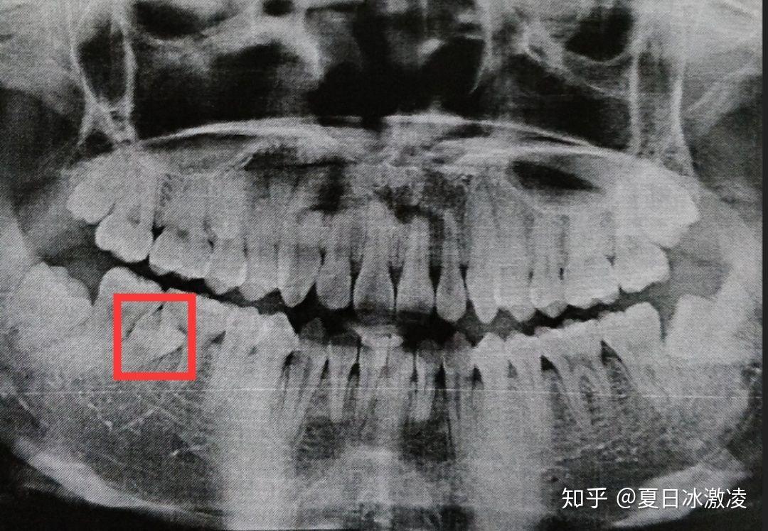 拔多生齿第二次体验后记 - 知乎