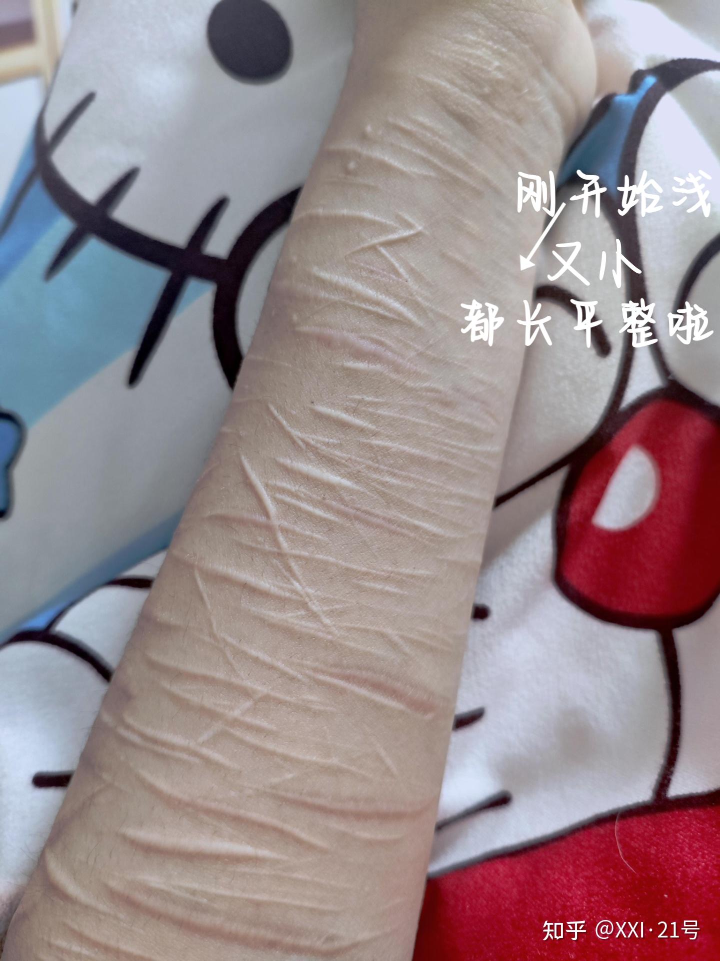 装抑郁的人会自残吗(孩子自残划伤手臂怎么办)
