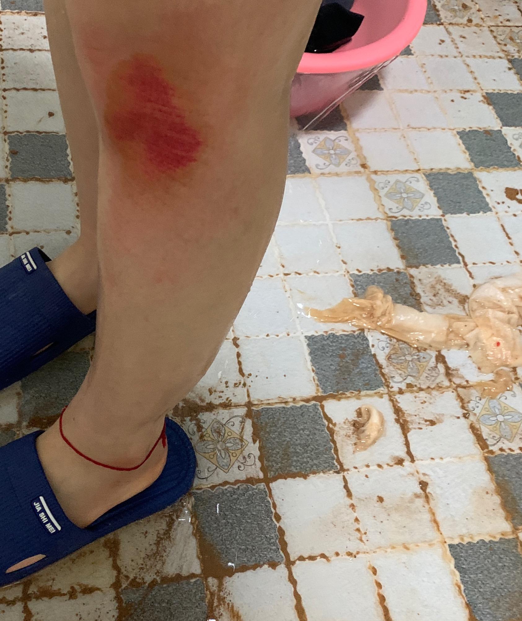 骑车摔倒擦伤怎么快速修复啊? - 知乎