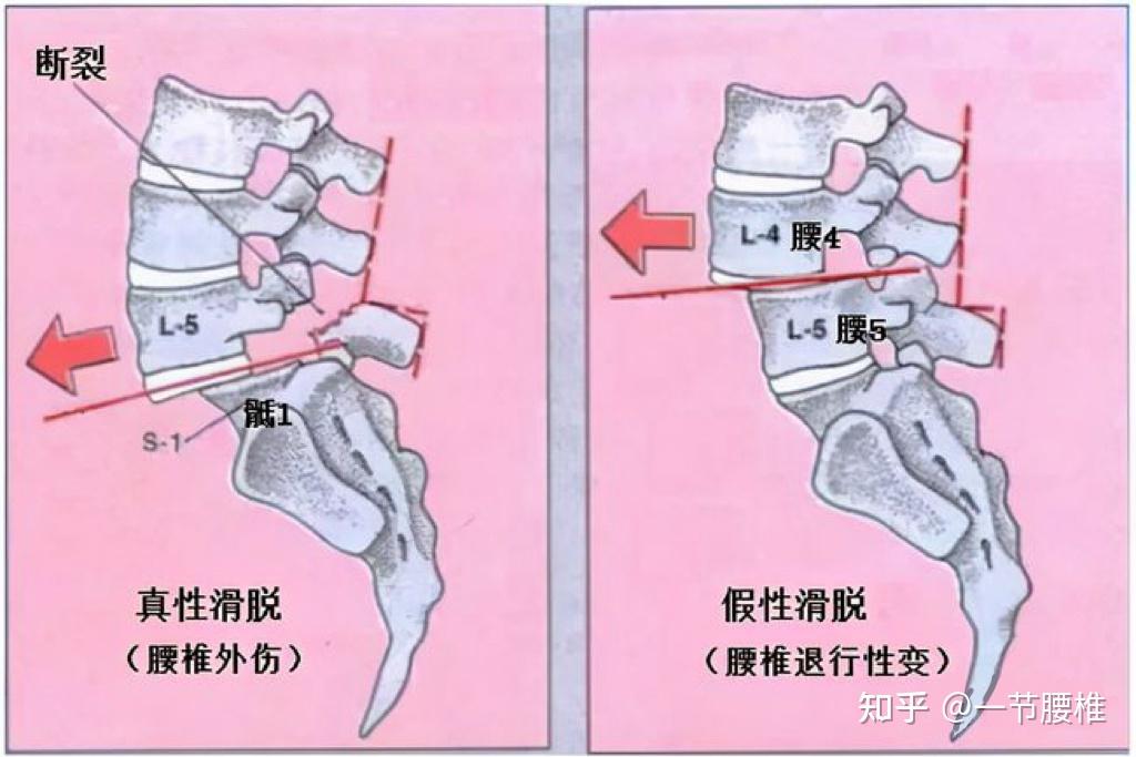 腰椎滑脱是怎么造成的图片