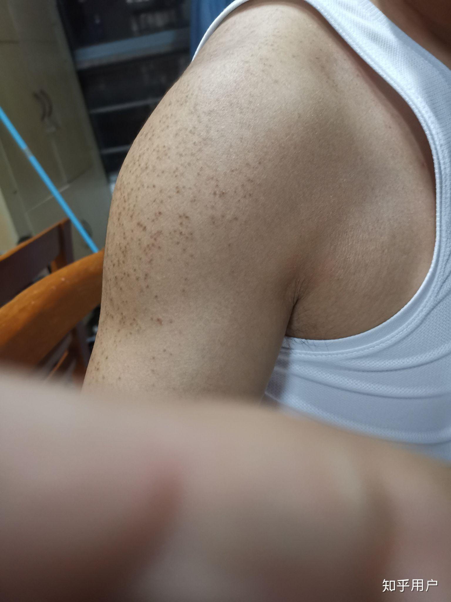 治疗背部的毛囊炎有哪些方法? - 知乎