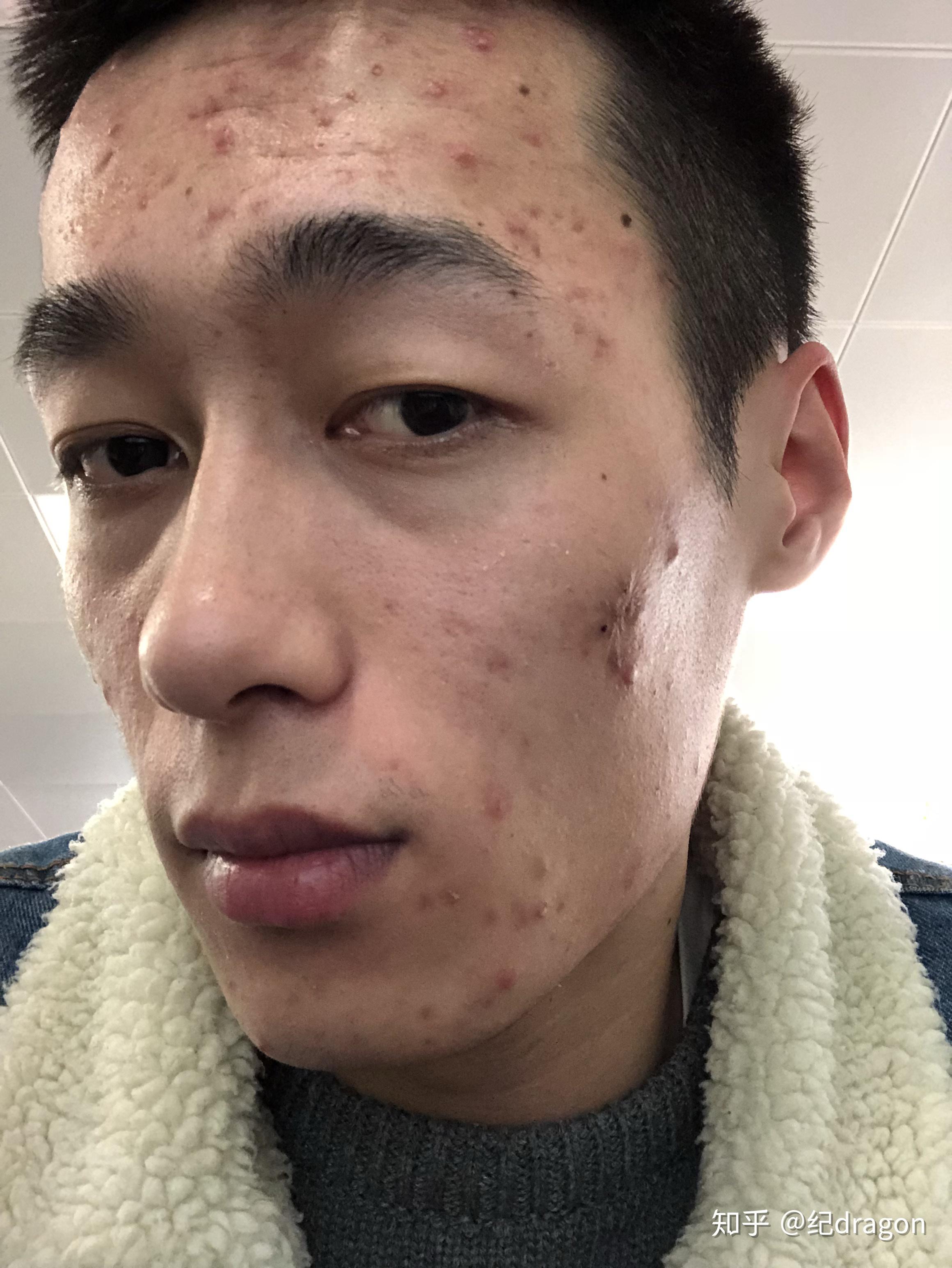 有没有用异维a酸isotretinoinaccutane治疗重度痤疮的经历