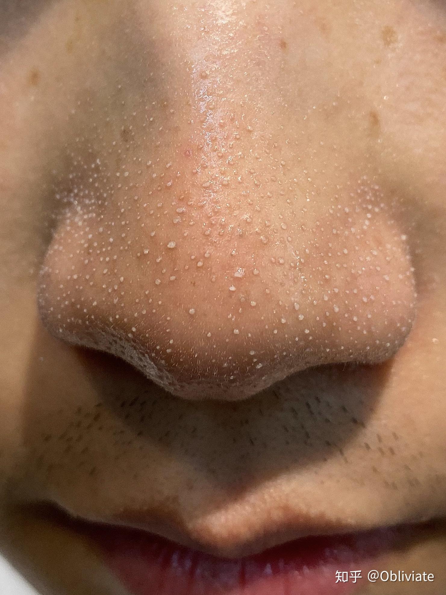 如何去除鼻子上的白头