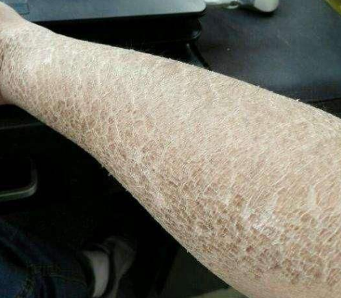 干燥综合征神经系统损害的调理