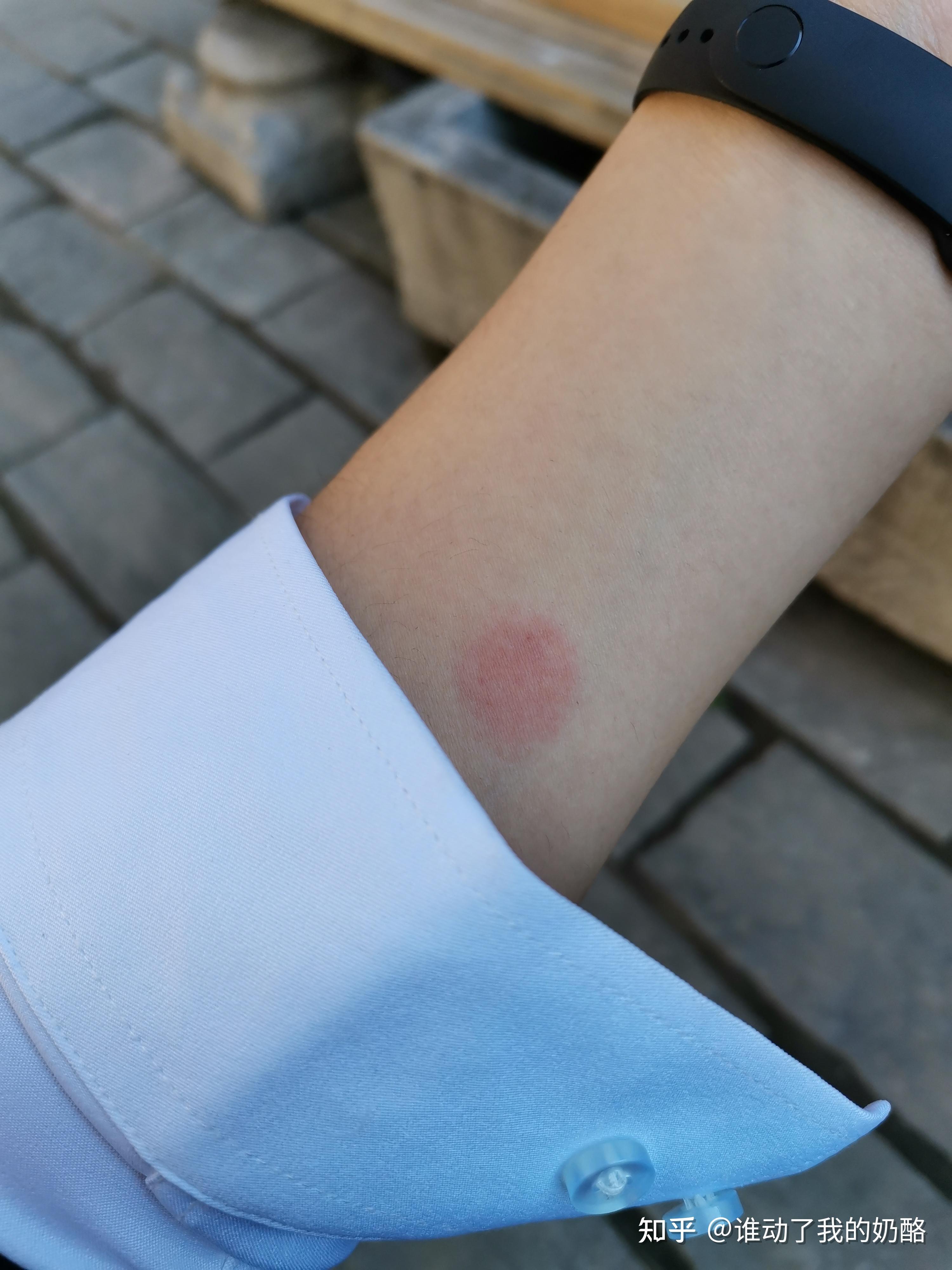 肺结核皮试怎样算是阳性? - 知乎