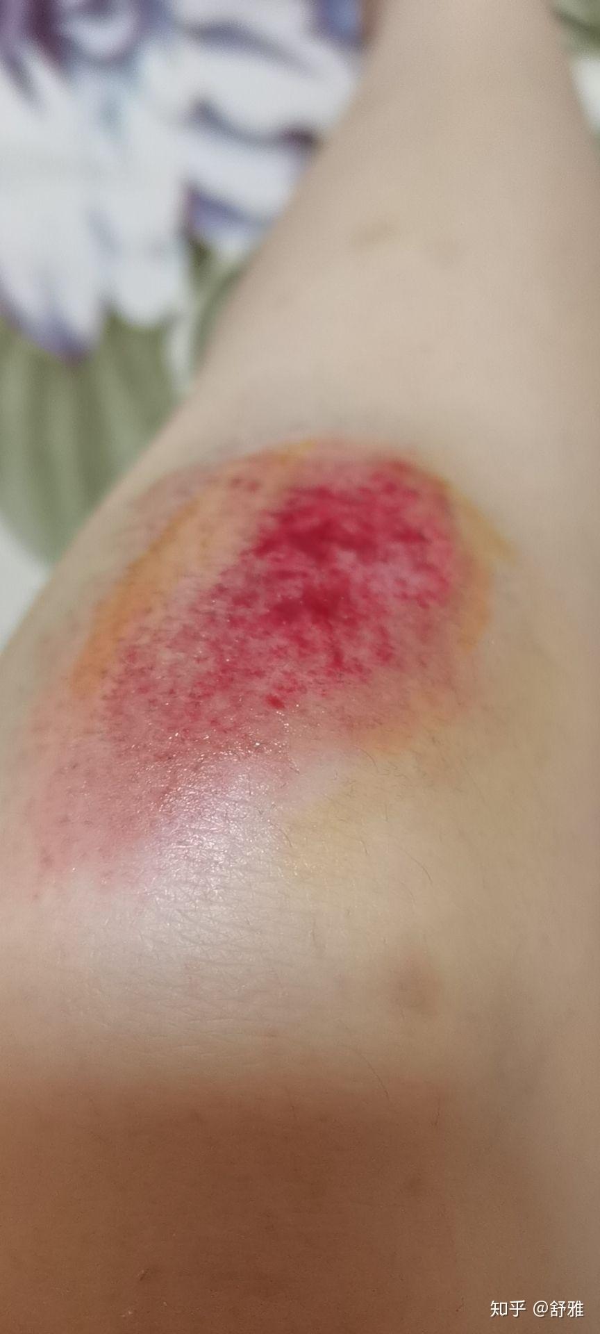 皮肤创伤擦伤的正确治疗方法是什么