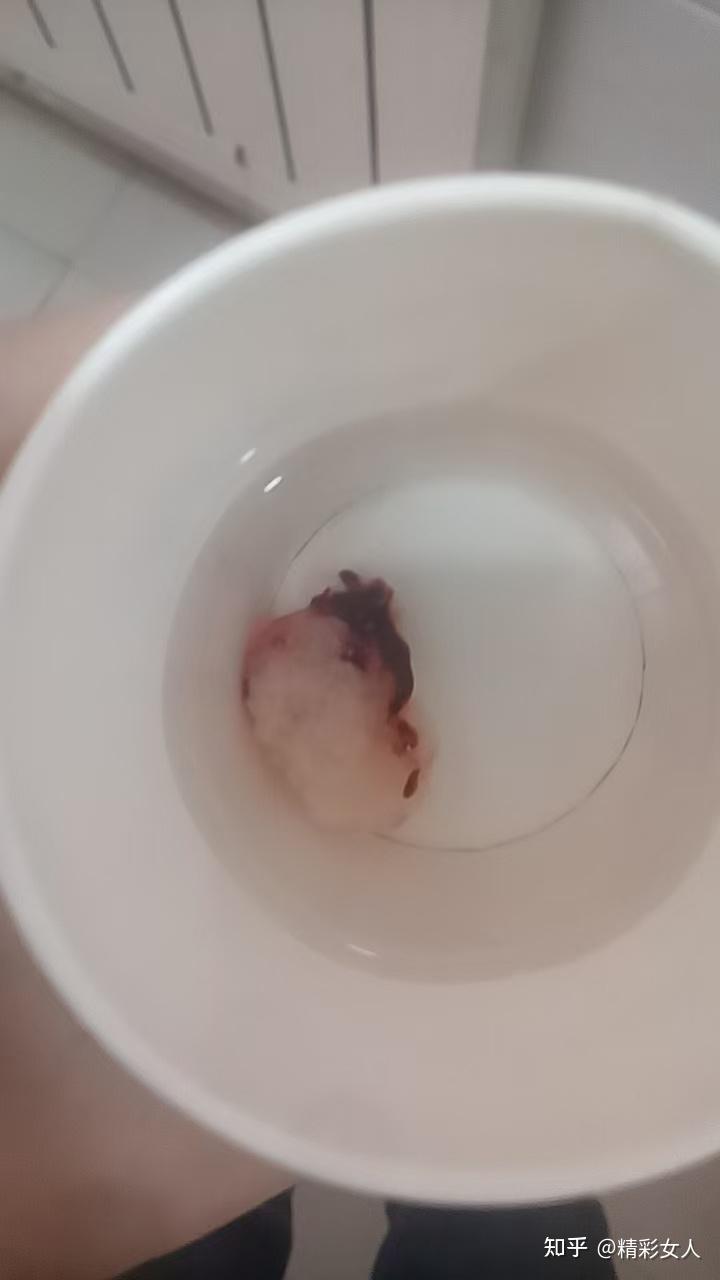 药流排出孕囊是什么样子,什么时候排出