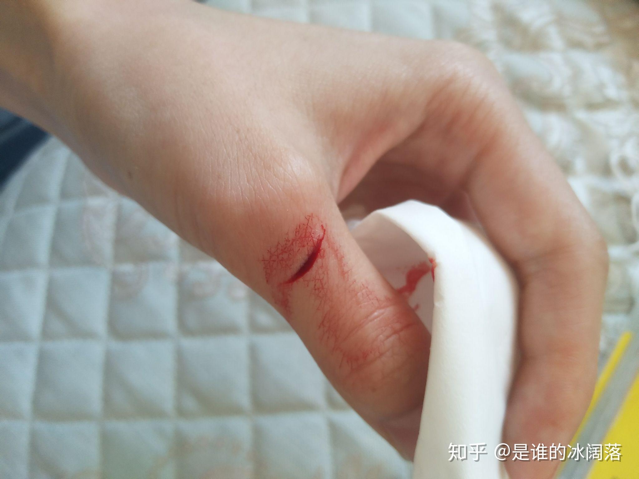 手被刀切了个深口子应该怎么处理
