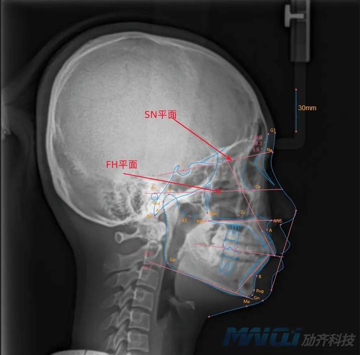头影测量标志点图解