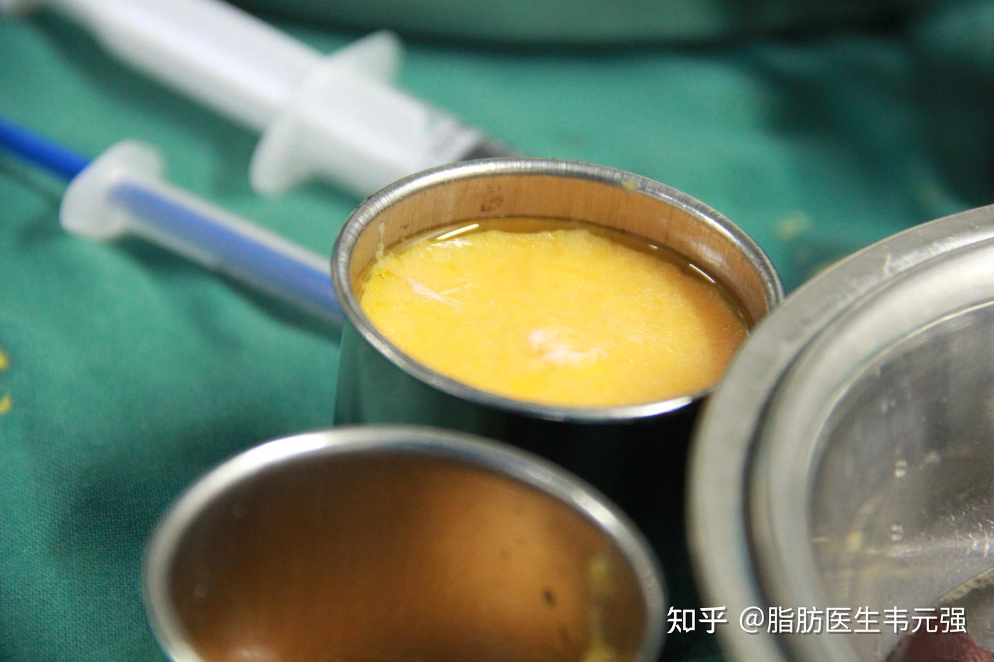 【真人实拍】自体脂肪丰胸手术全过程，全网最真实记录！ 知乎 