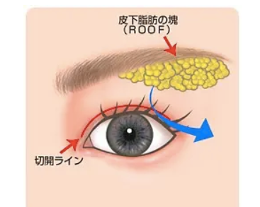 什么是roof脂肪层