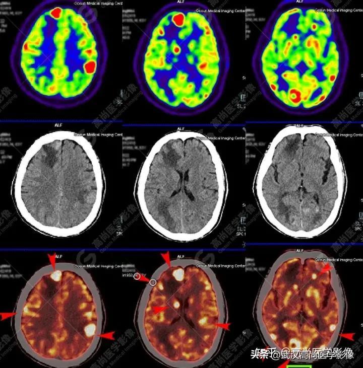 一针辨真伪——超声引导下颈部淋巴结穿刺活检1例