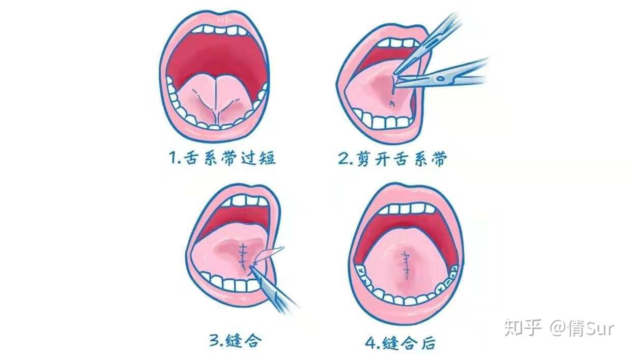 成年人舌系带有点影响说话，剪掉好还是不剪掉好？剪掉后有没有什么影响？ - 知乎