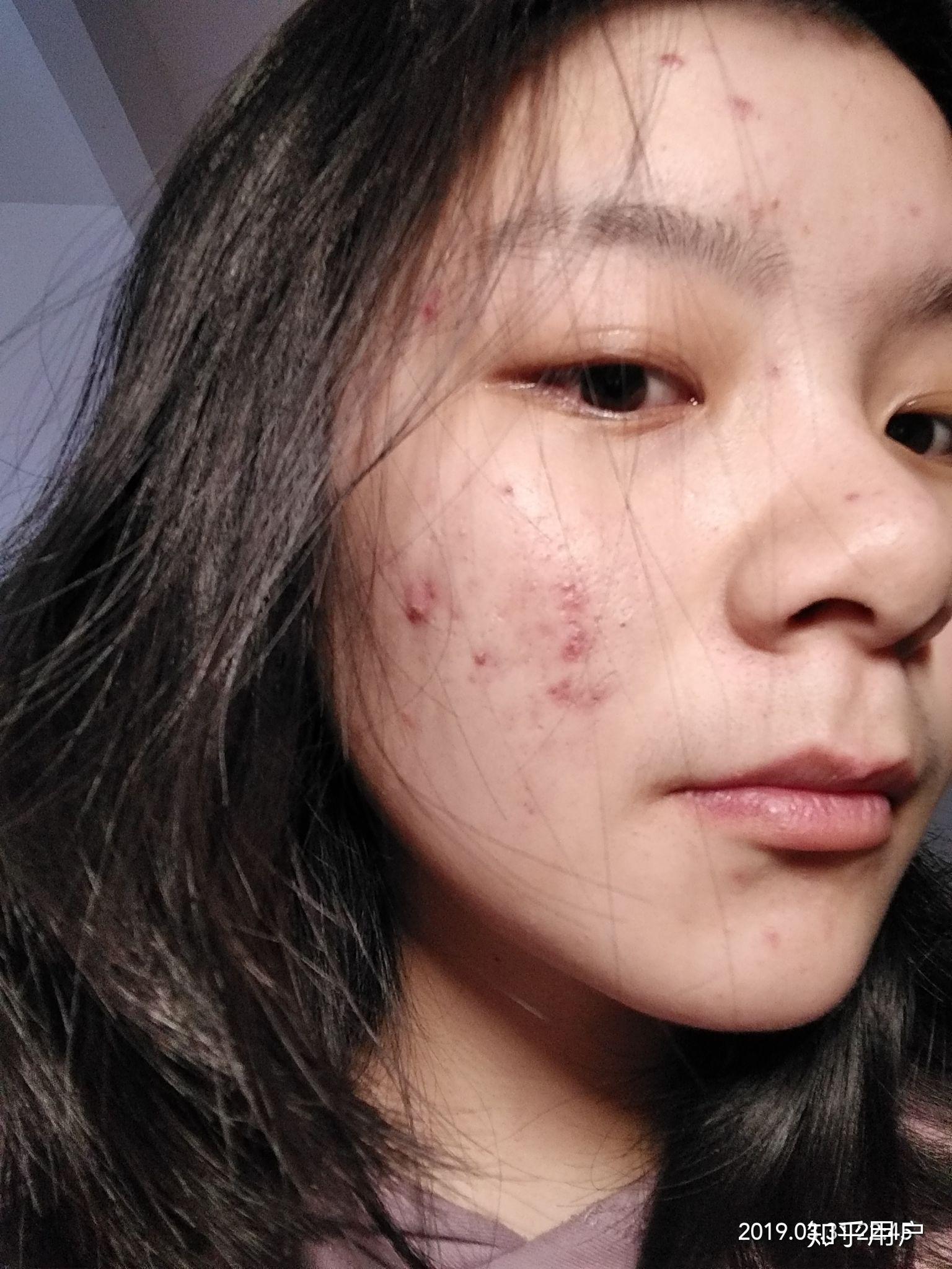 有没有长得好看但长痘痘的女生? - 知乎