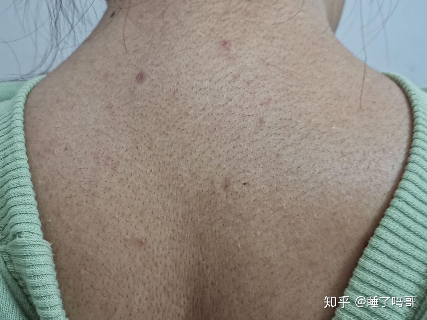 我背部毛孔粗大,而且好像有的毛孔里不止一根汗毛的样子,怎么办?