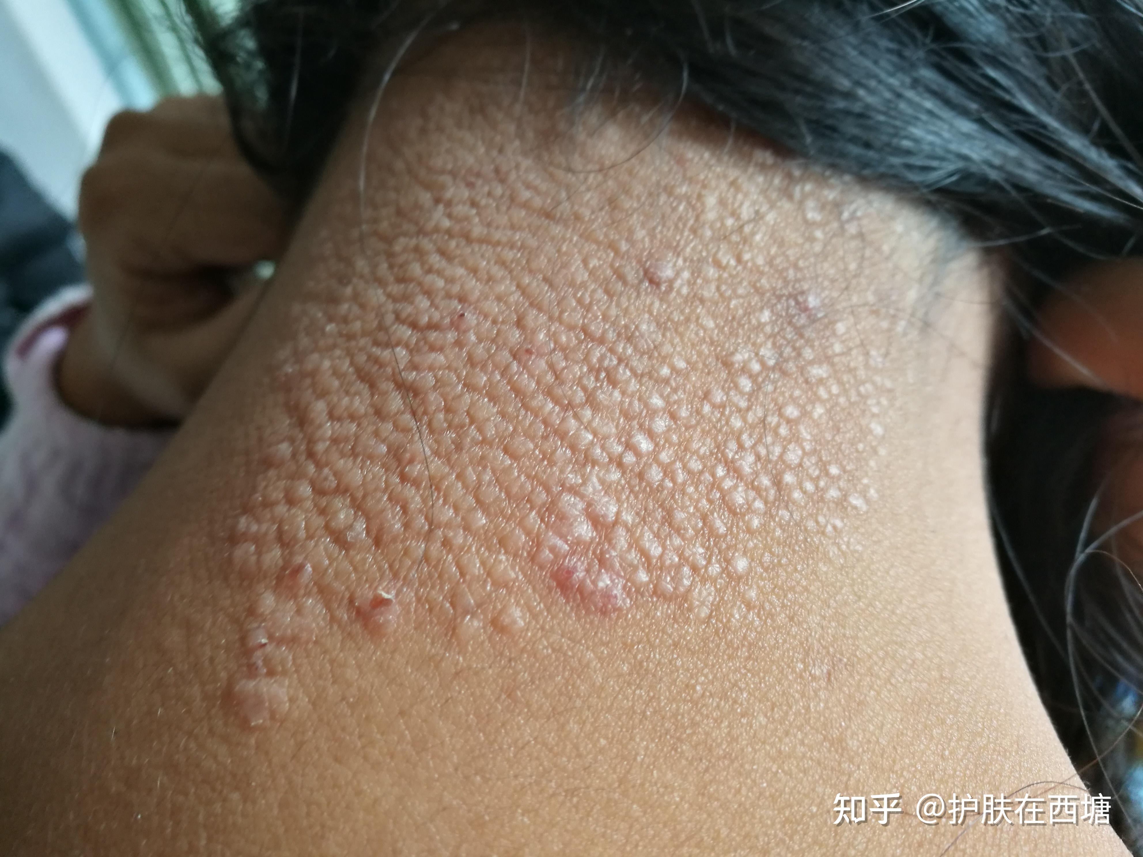 不单纯的神经性皮炎 - 知乎