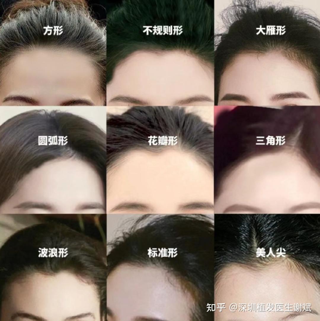 发际线植发,如何避免生硬不自然的发际线? - 知乎