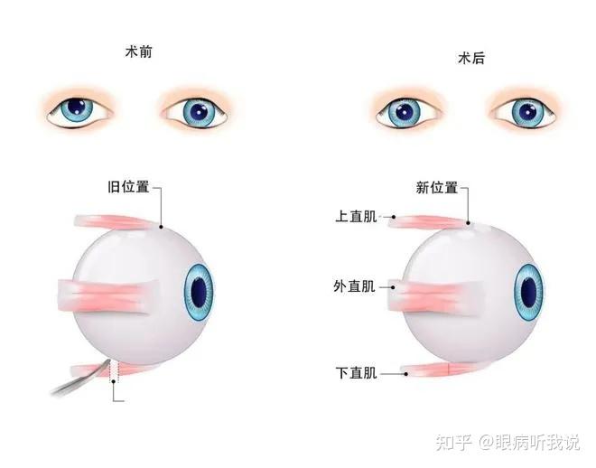 【夏日暑期】斜视手术攻略‼️建议人手一份! - 知乎