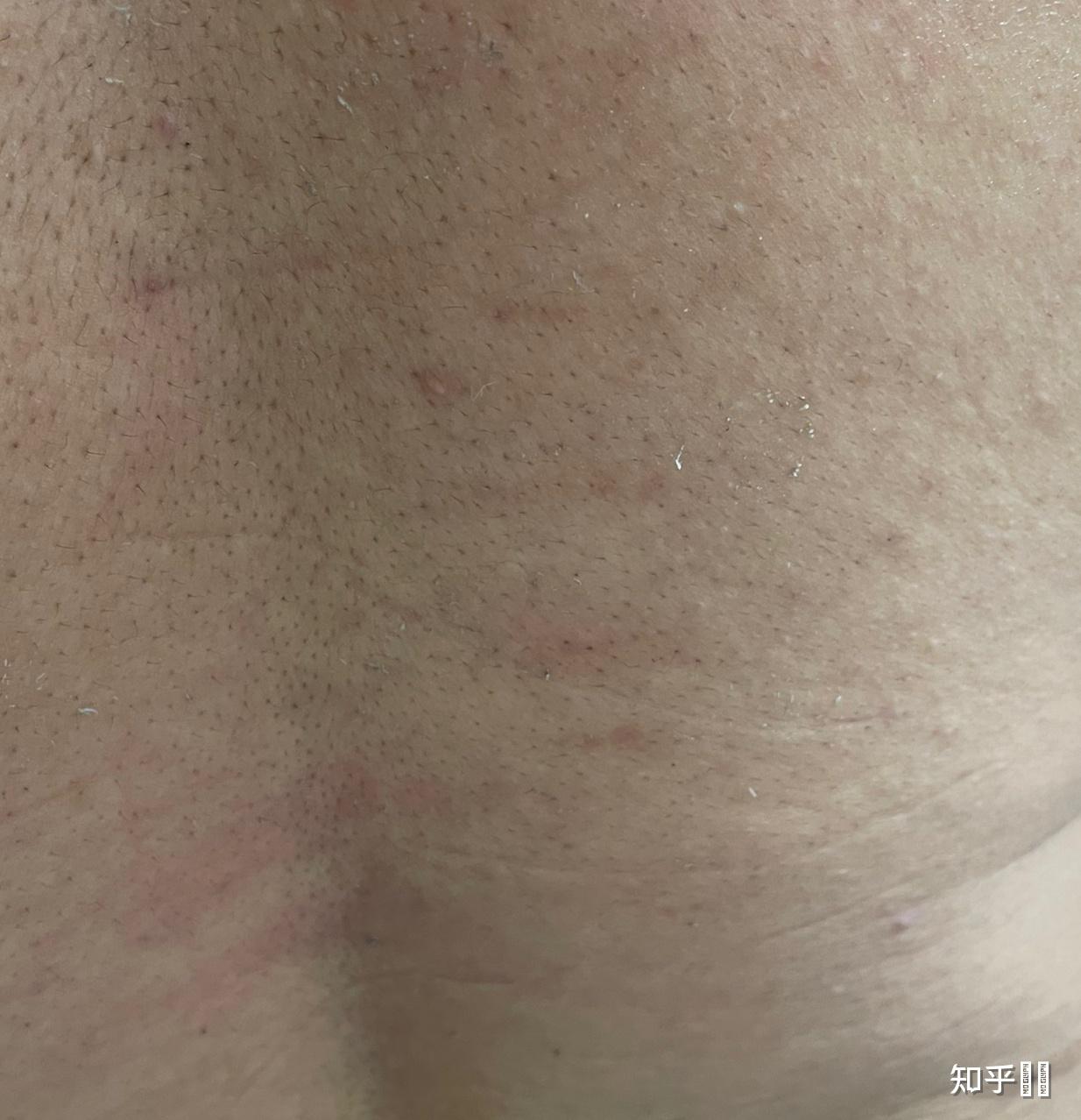 男朋友背后这种抓痕是出轨了吗 ?绝不是我抓的? - 知乎