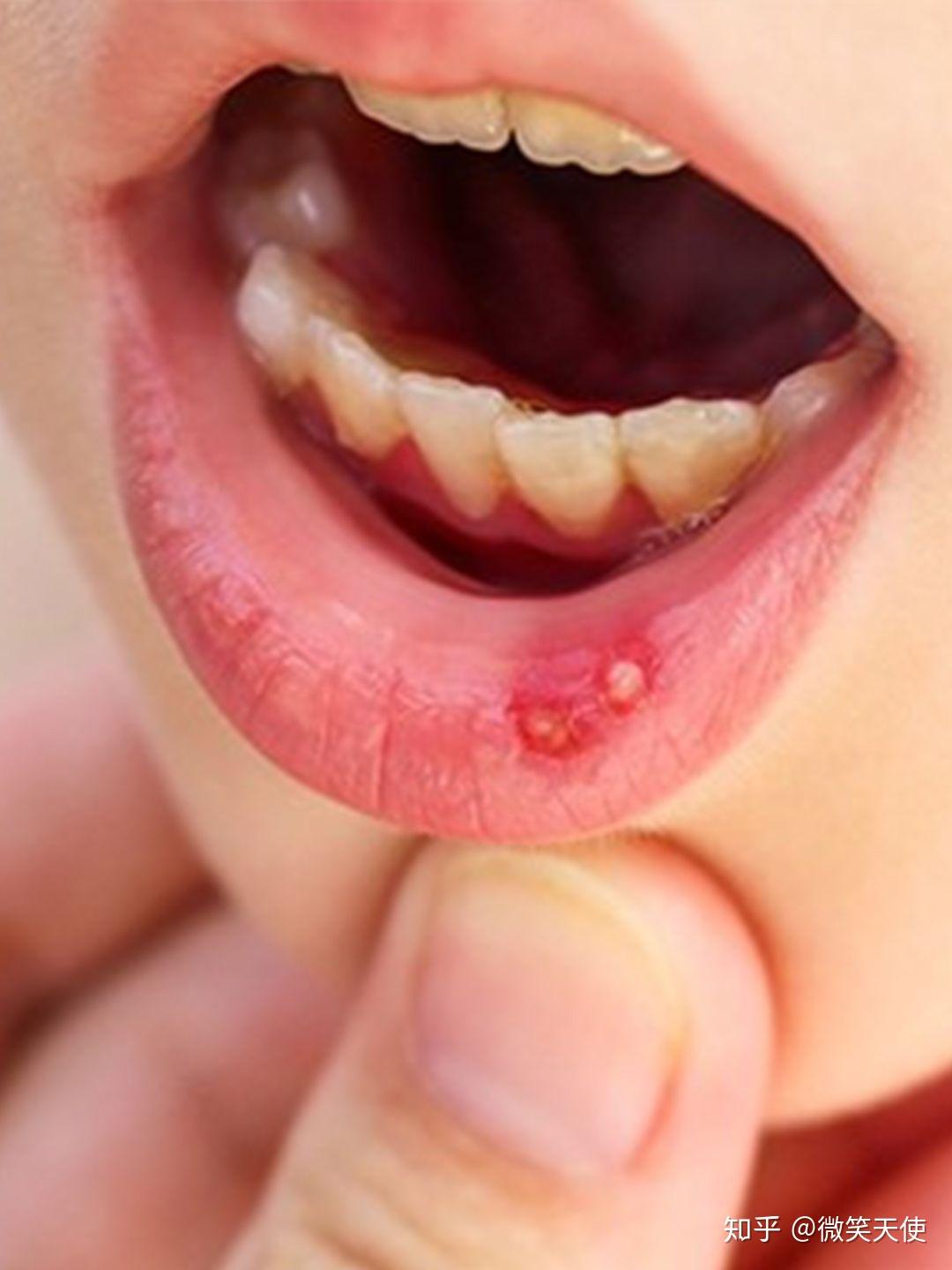 口腔溃疡怎么样才能好的更快? - 知乎