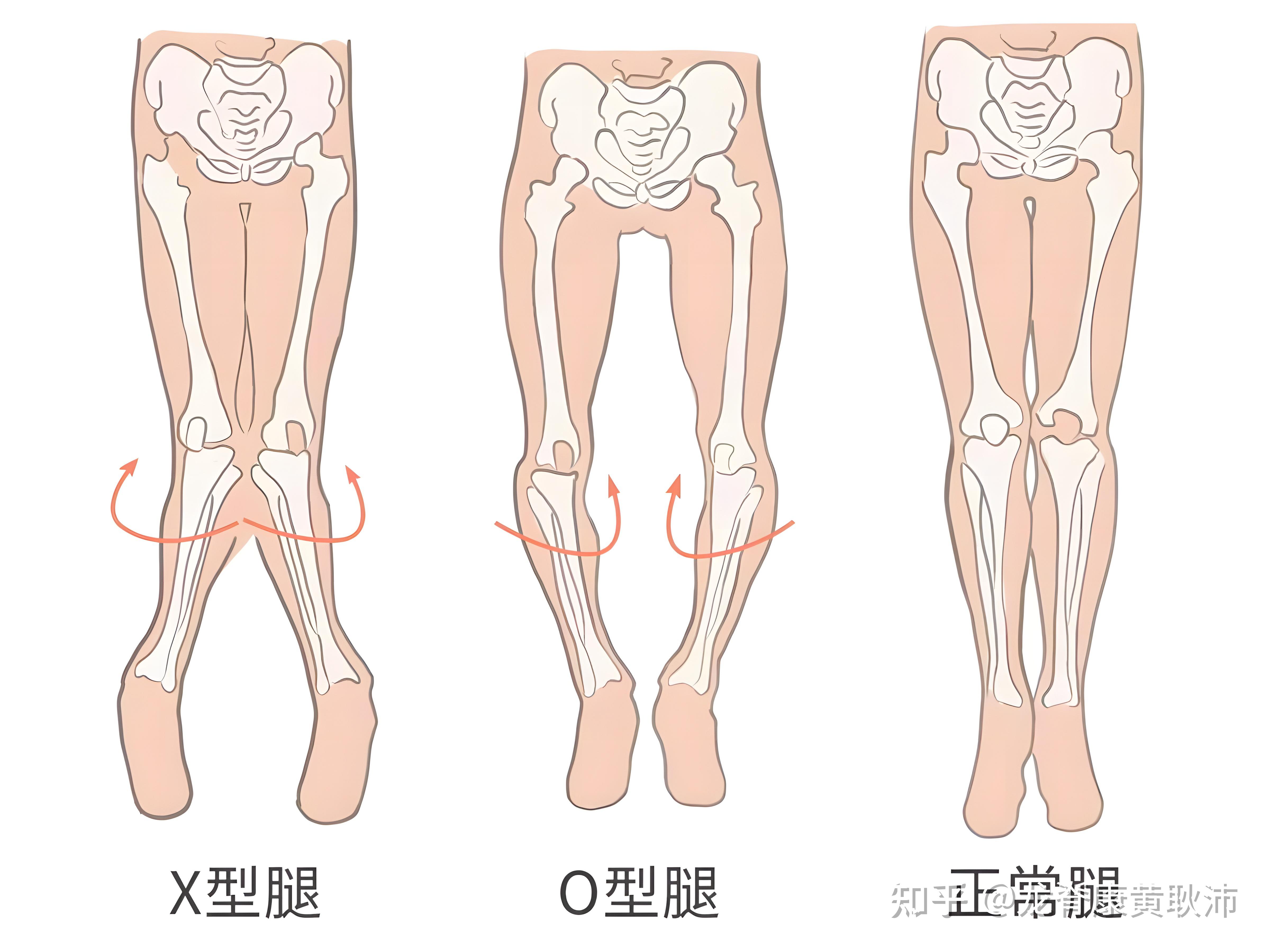 xo型腿绑腿矫正图解图片