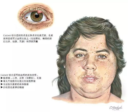 国内治疗库欣综合征有哪些方案? - 知乎