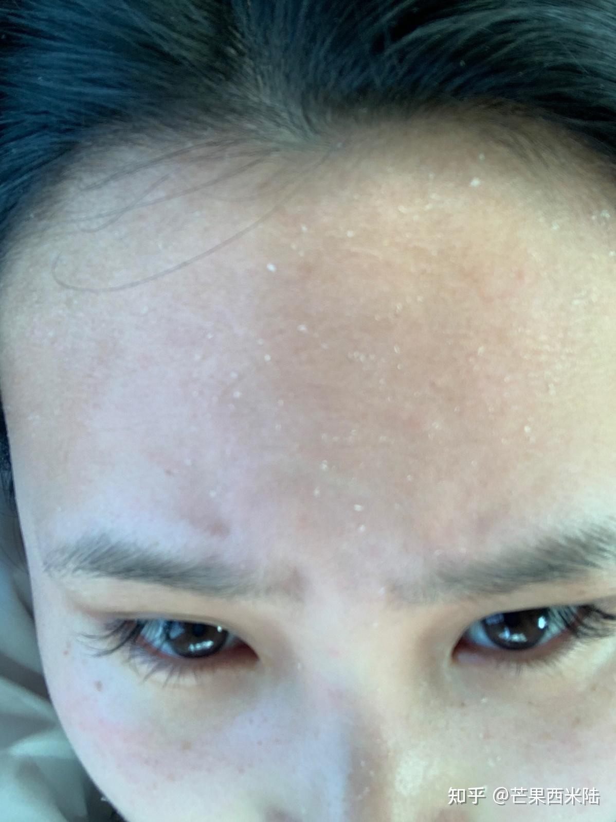 皮肤老是干的起皮儿怎么办? - 知乎