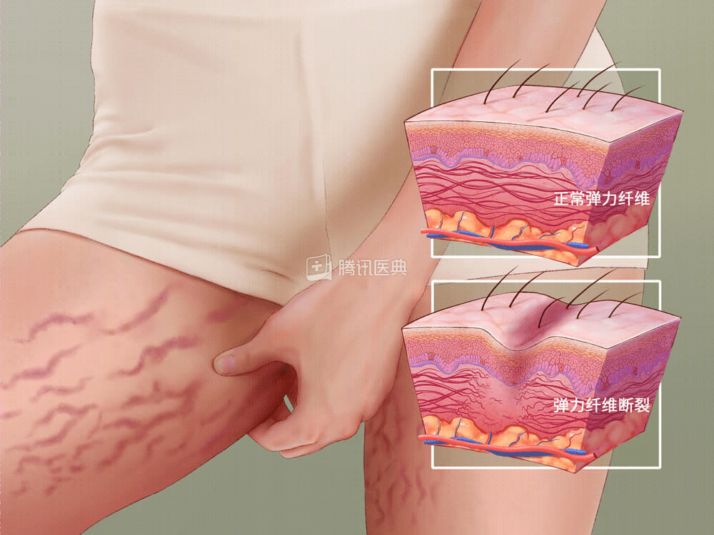 有肥胖纹就一定会有妊娠纹吗?有没有办法预防啊? 