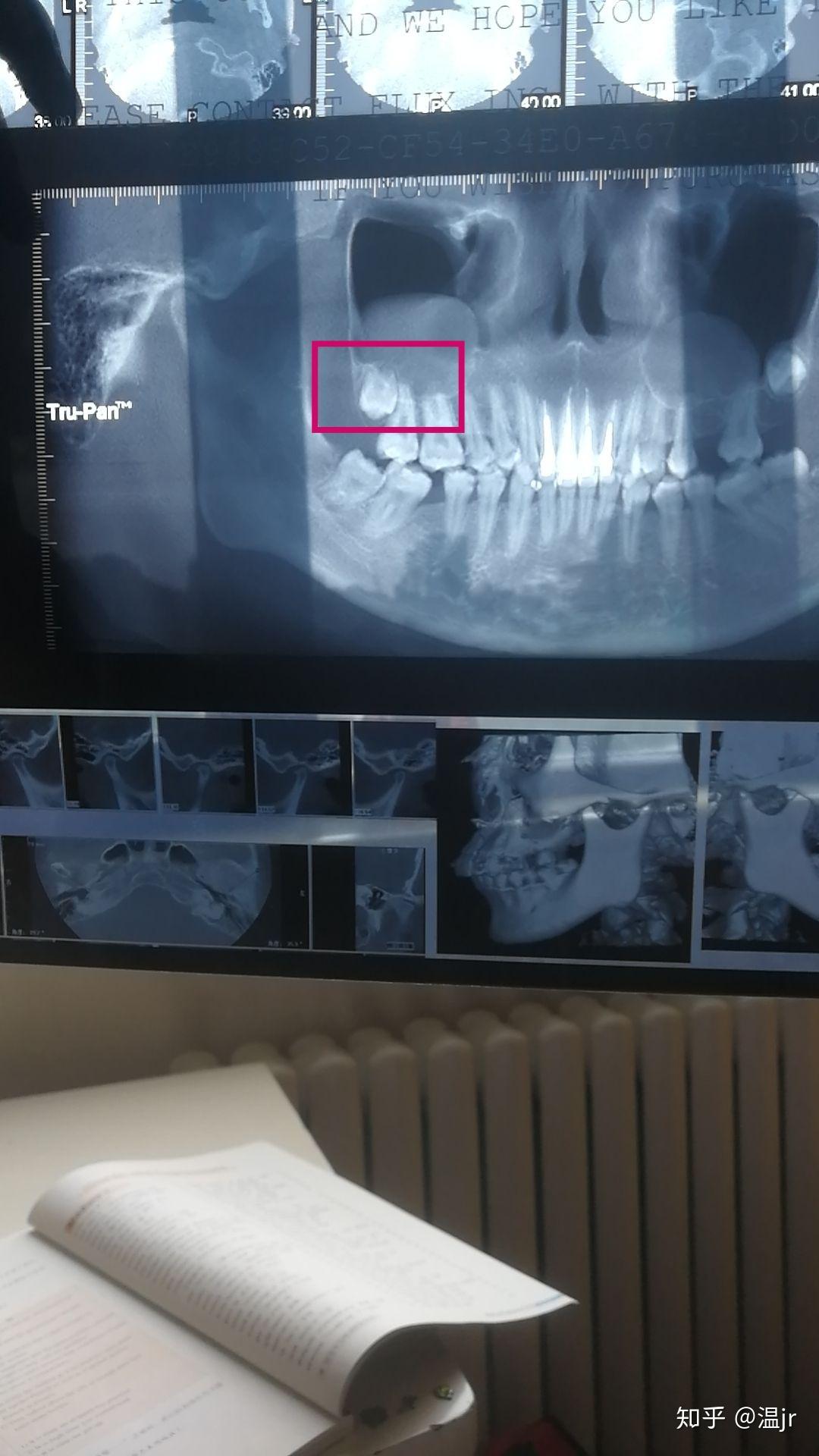 拔智齿,连通上颌窦严重吗? - 知乎