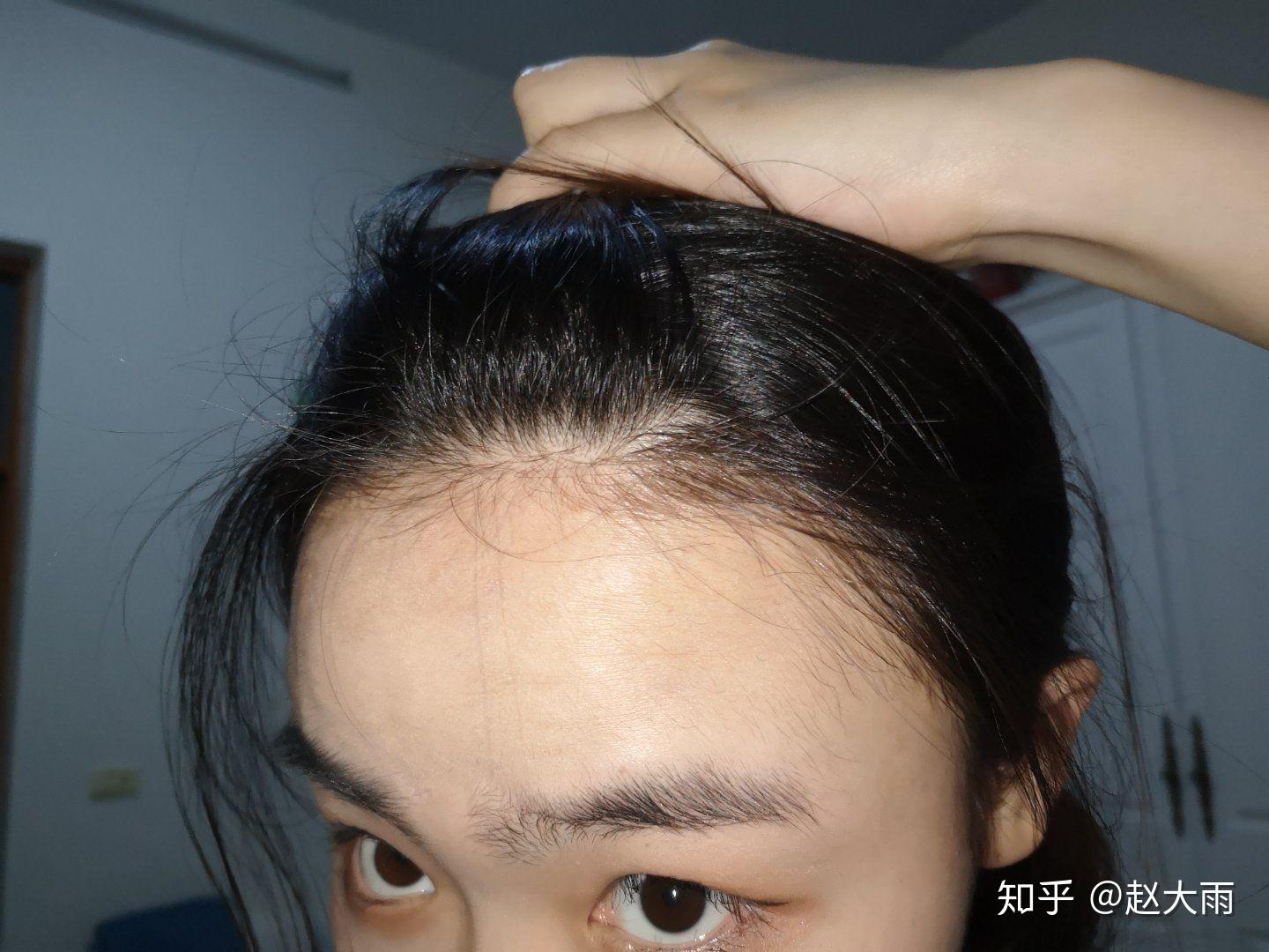 女生发量少头顶快秃了有没有什么好的生发方法跪求