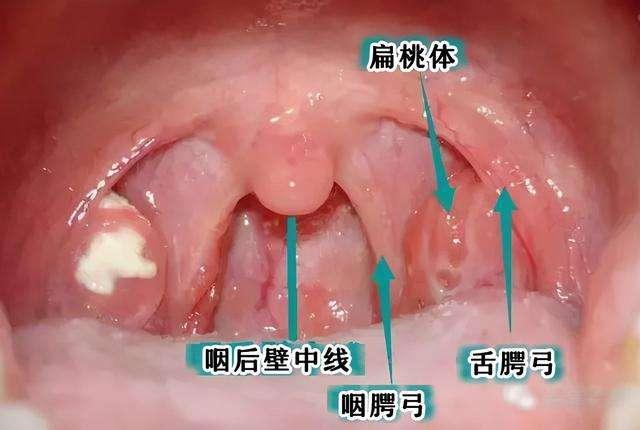 扁桃体有坑图片