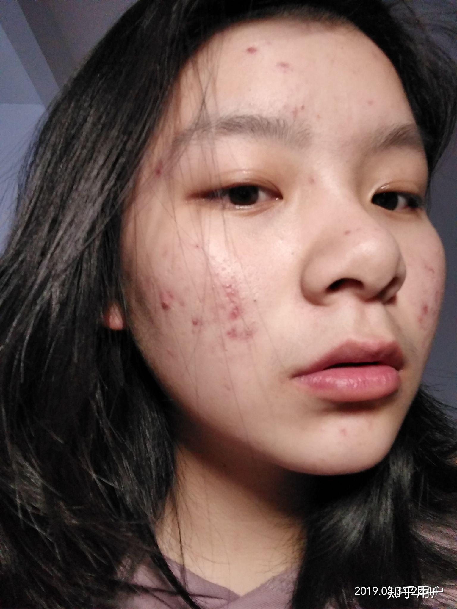有没有长得好看但长痘痘的女生? - 知乎