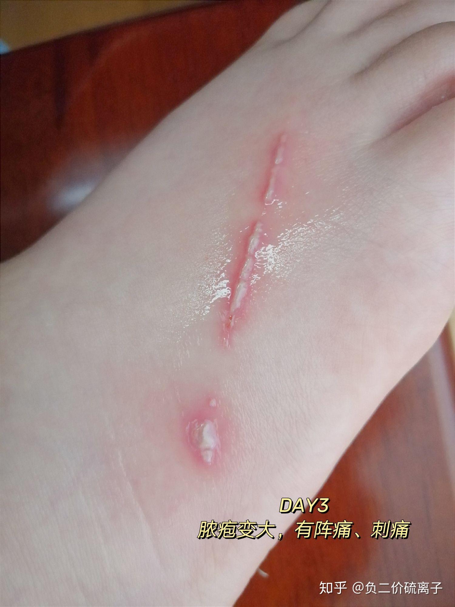 隐翅虫咬后的水泡能不能挤? - 知乎