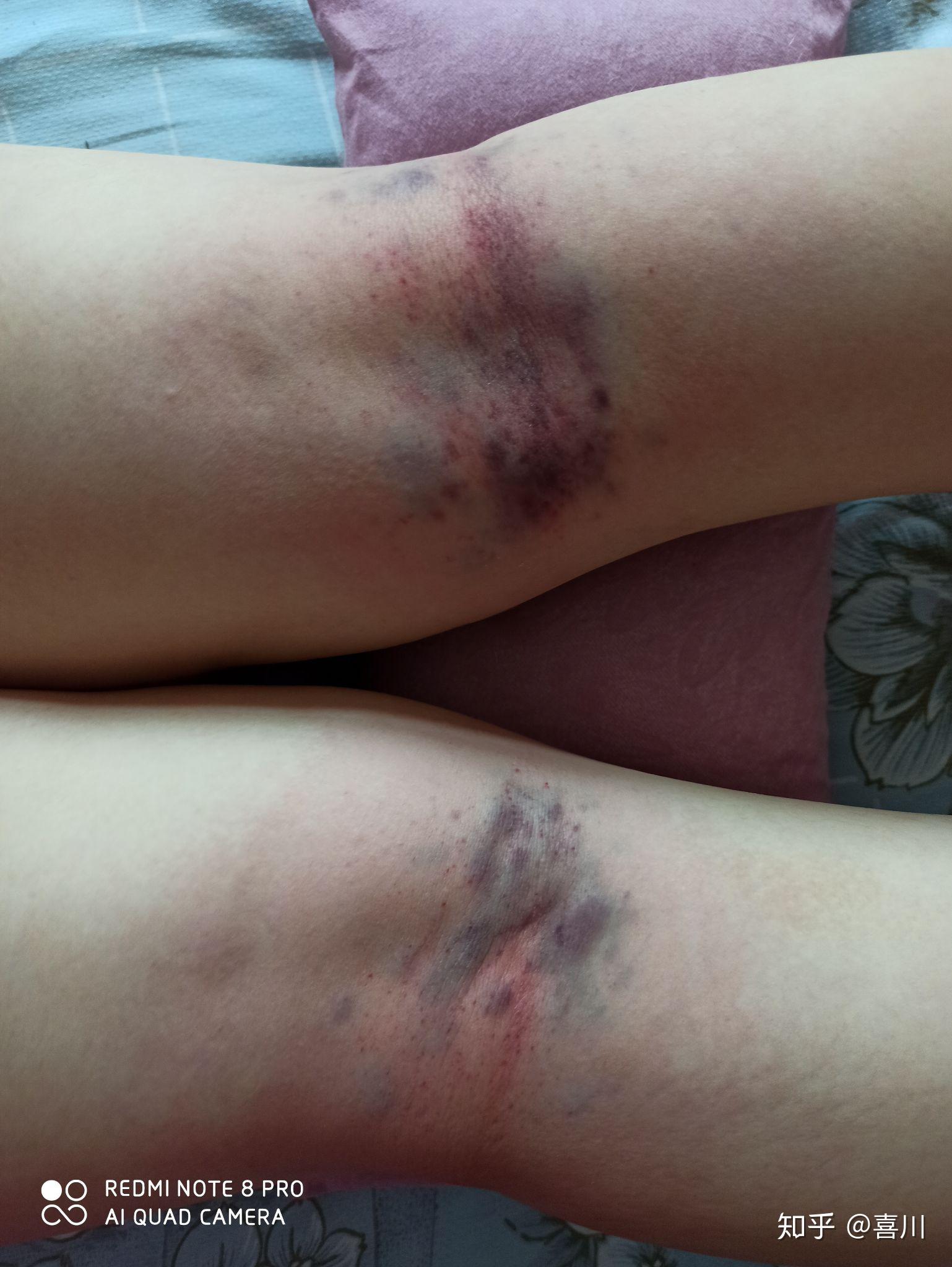 拍打手肘窝真的可以排毒吗? ? - 知乎