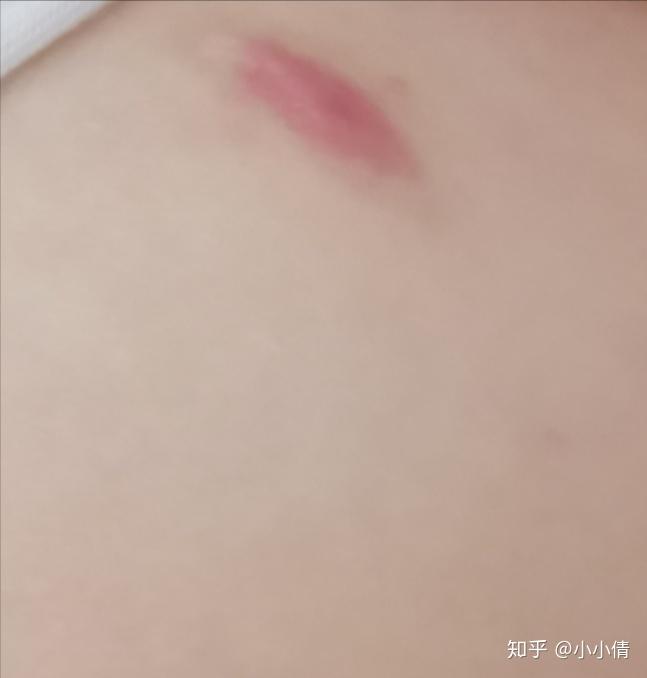有没有女孩子得过乳腺纤维瘤啊? - 知乎