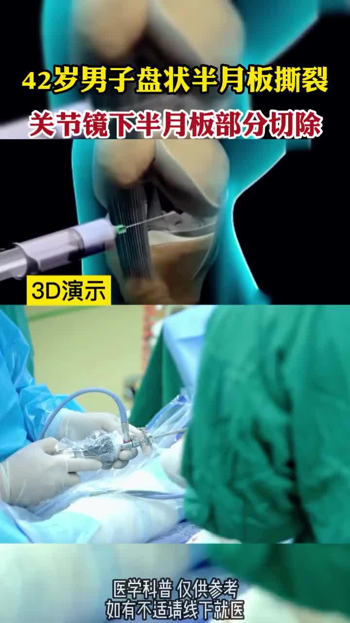 男子盘状半月板撕裂关节镜下半月板部分切除
