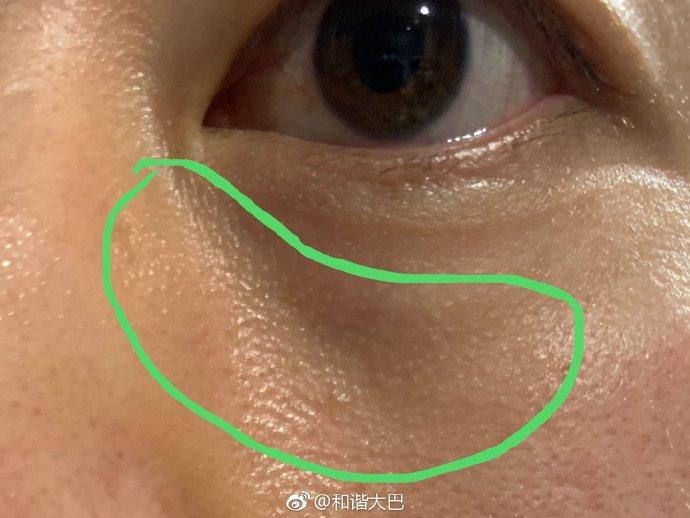 眼周脂肪粒怎么处理