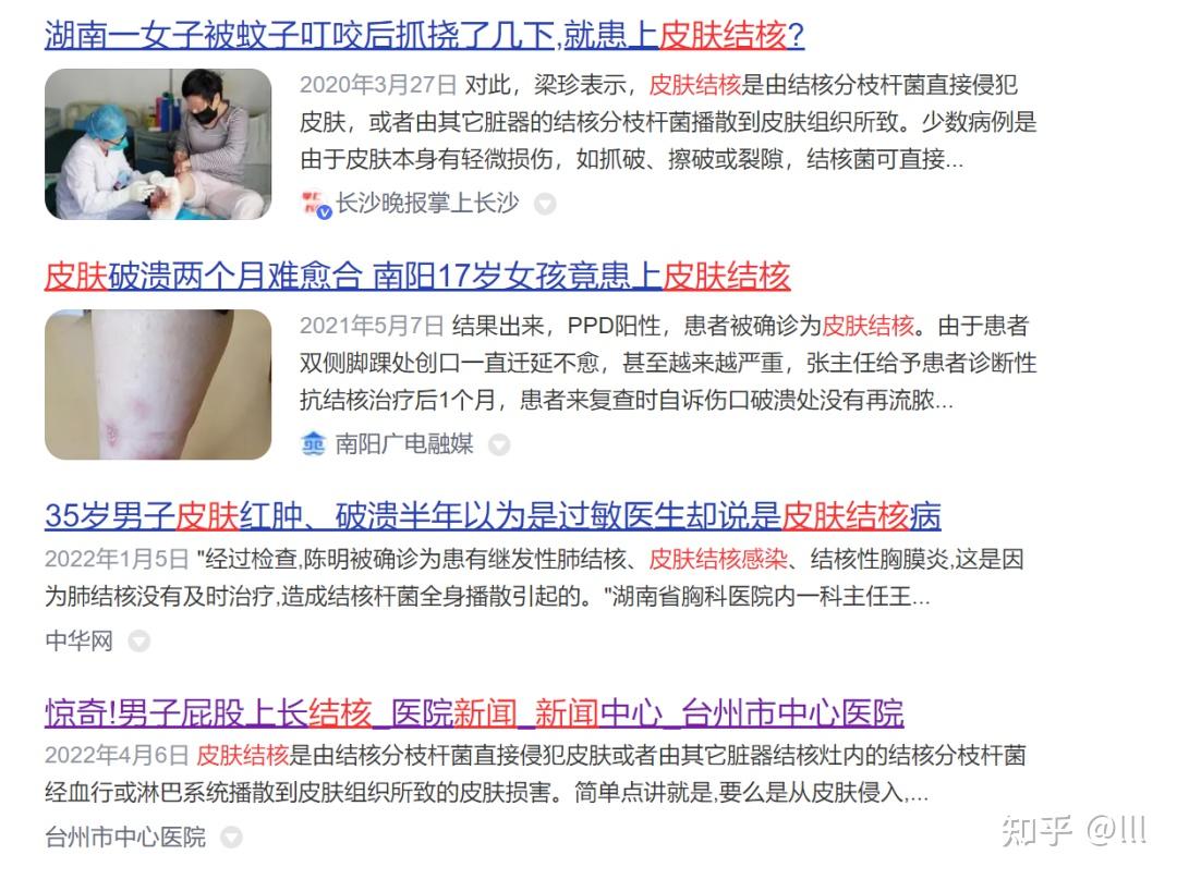 皮肤也会感染结核病 皮肤健康需关心 - 知乎