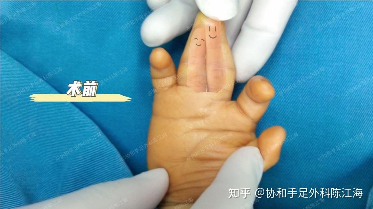并指免植皮 | 案例14《“菱形”并指分开之后，小手力量很不错》 - 知乎