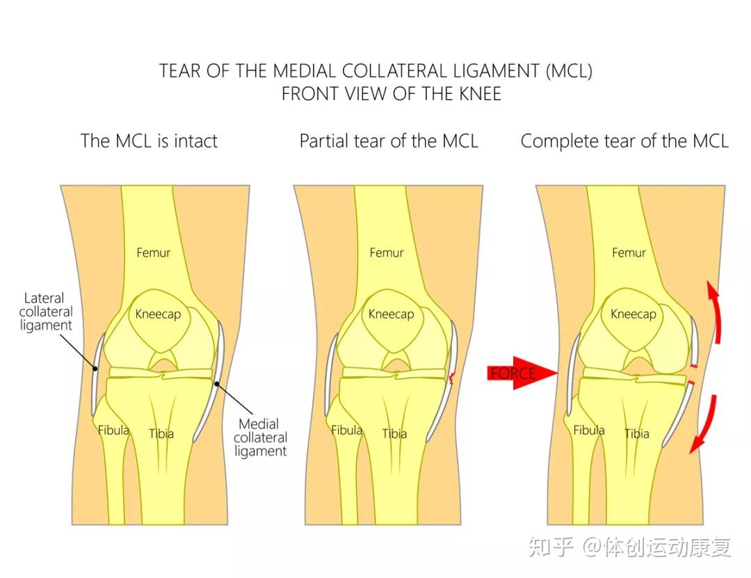 膝蓋內側副韌帶損傷怎麼自查回覆情況