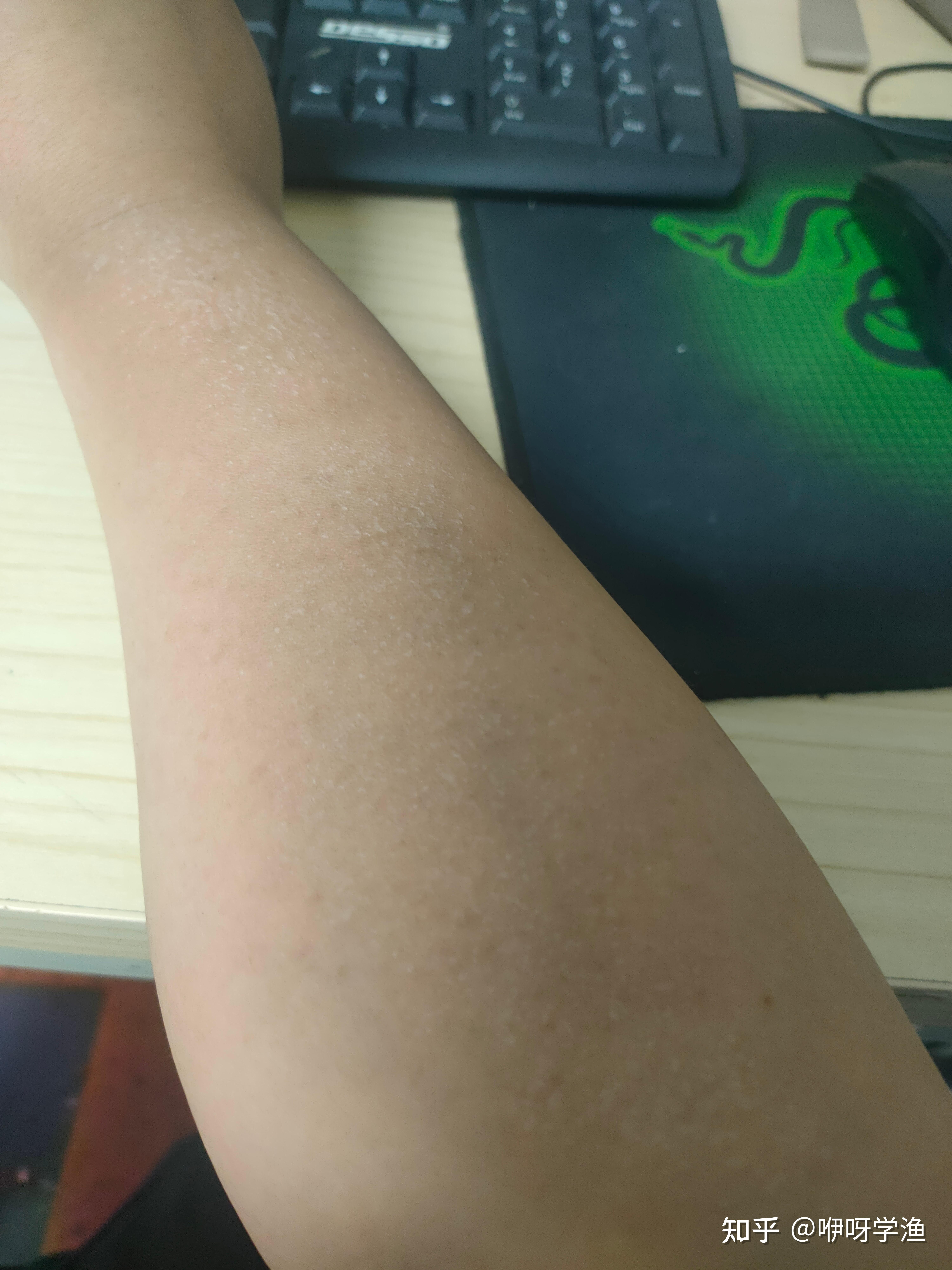 大夏天白天经常出去钓鱼,洗完澡手臂上就这样了,是什么情况?