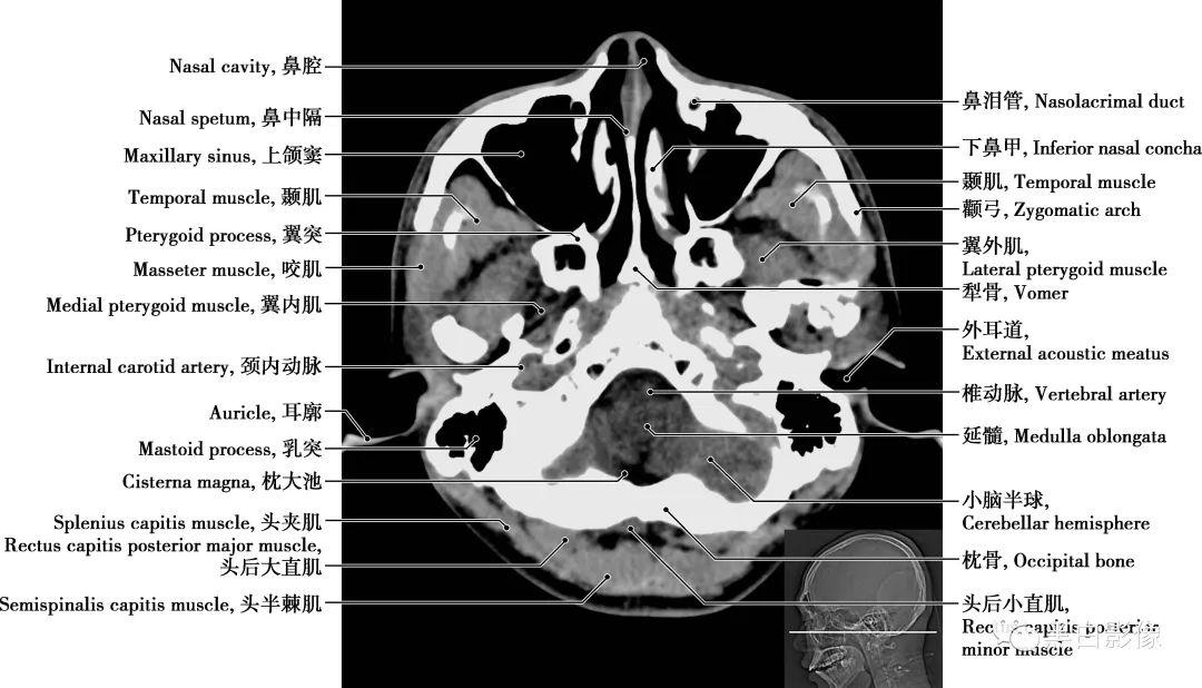 详细标注版!颅脑CT正常解剖图谱 - 知乎