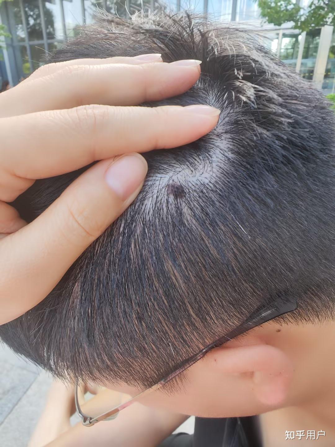 头皮上长了个这个,是黑色素瘤吗? - 知乎